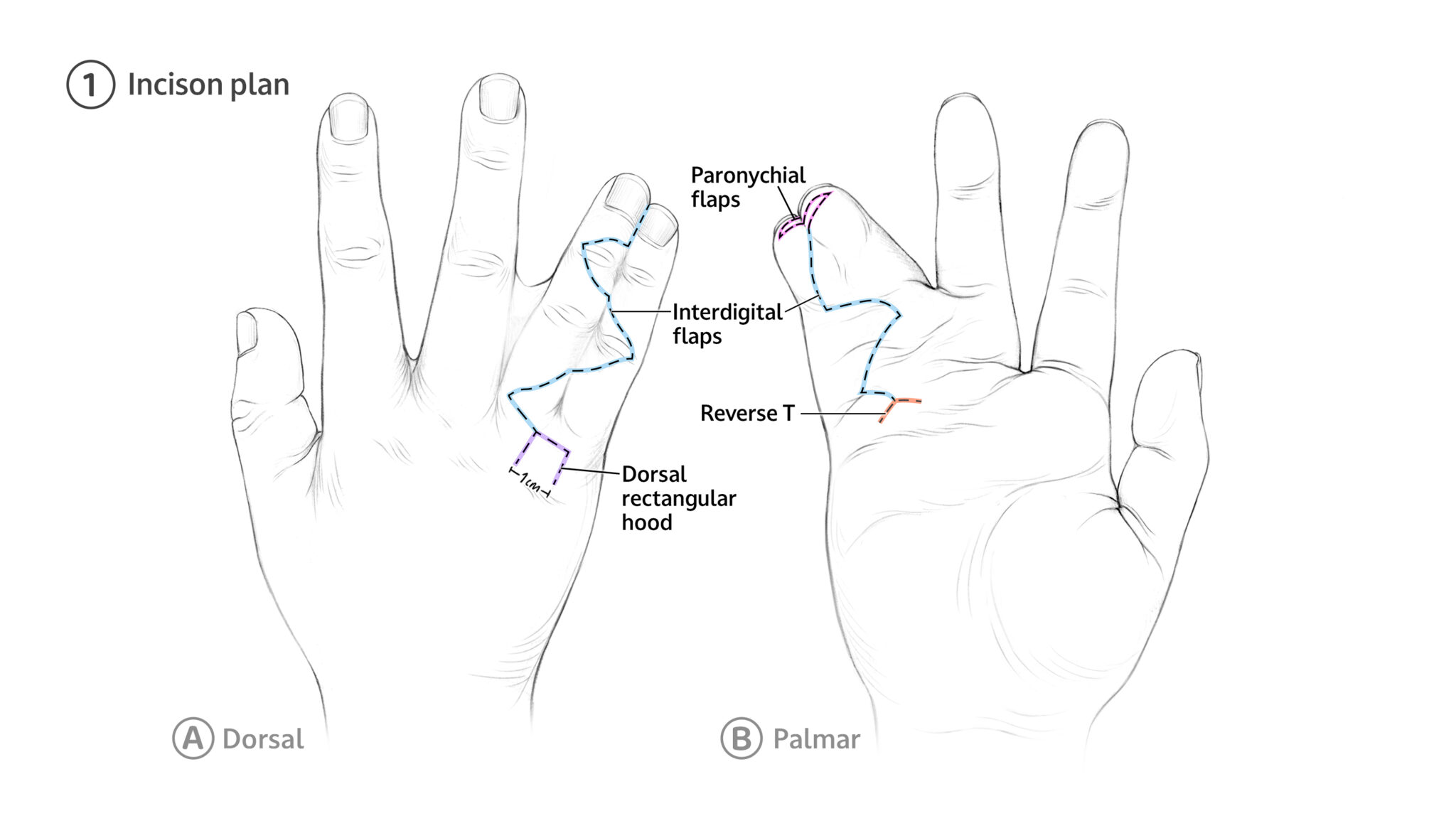 1A Dorsal planned incisions including division of the shared nail plate, creation of interdigital flaps, and design of a rectangular web hood for web-space reconstruction. 1B The palmar view demonstrates the planned paronychial flaps which are the V shaped incisions at the finger tip that will form the skin fold bordering the divided nail plate. Also detailed are interdigitating flaps, and a reverse T-shaped incision which is placed more proximally than than the native web space to account for postoperative web creep.