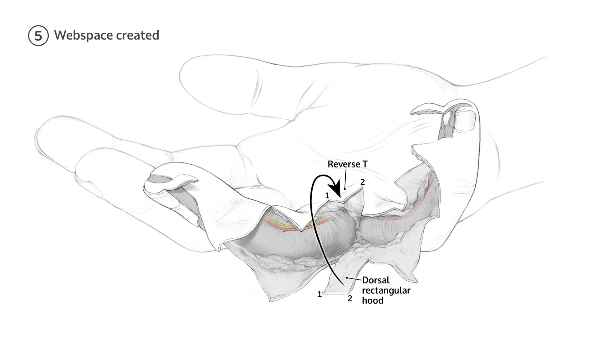 5 The dorsal rectangular hood is advanced and inset to the reverse T-shaped incision for webspace reconstruction.