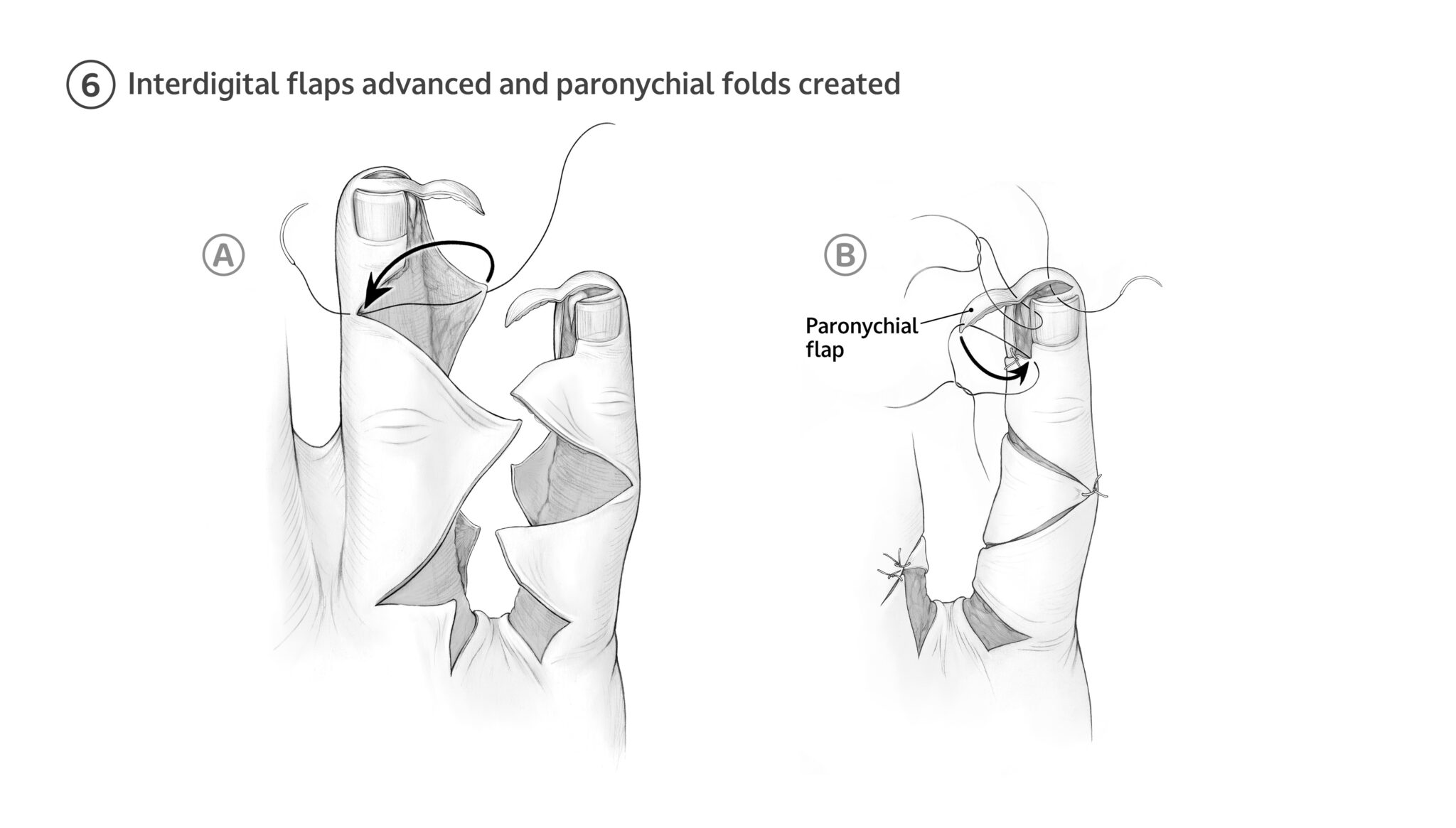 6A Interdigital flaps are advanced to their respective side of each digit, avoiding tension or vascular compromise. 6BParonychial flaps are inset and sutured forming the paronychial folds which border the nail plate.