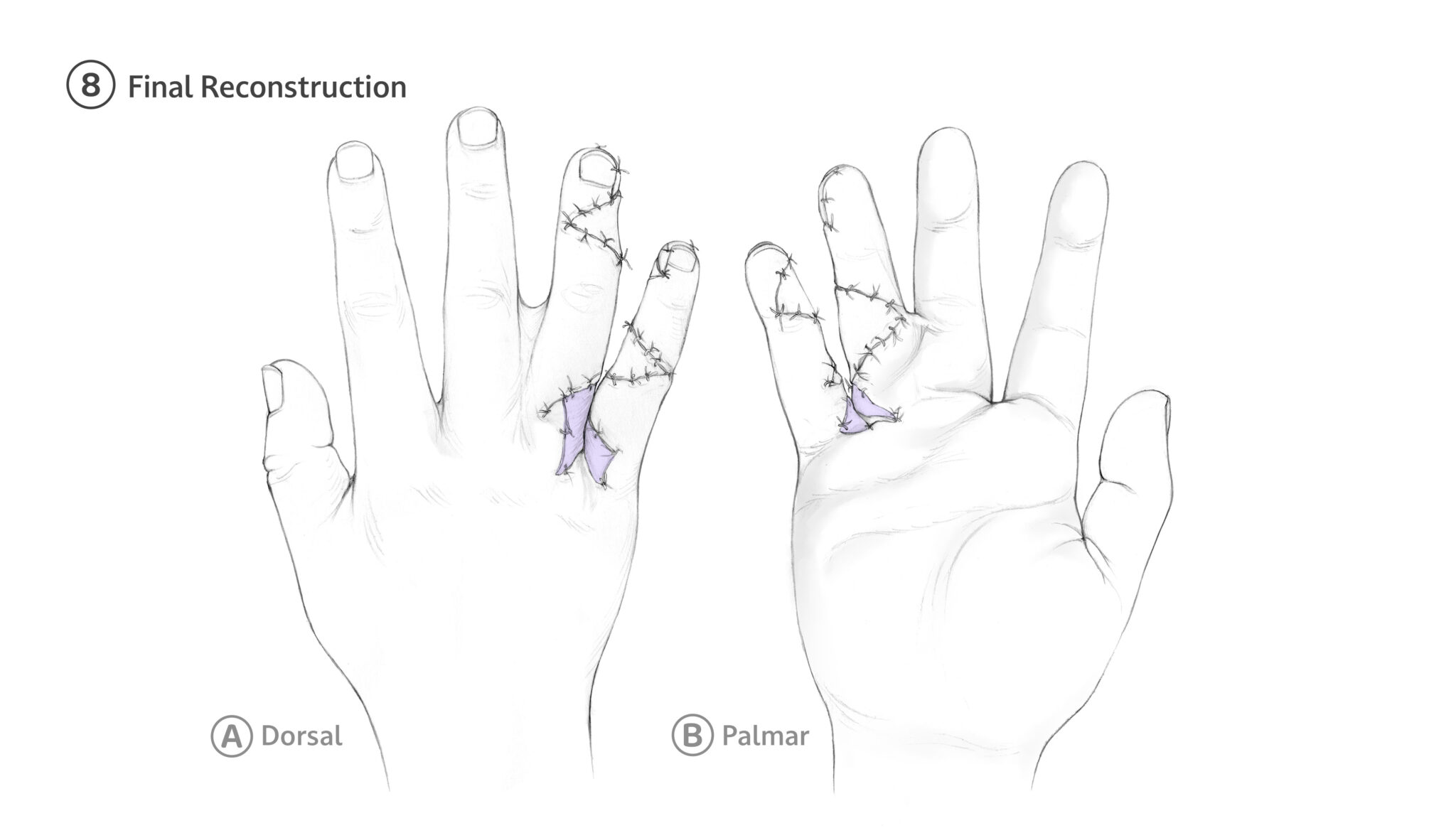8 The completed reconstruction shows fully separated digits with restored web spaces. Areas of gaping are closed with simple interrupted sutures. Complete skin coverage is confirmed and fingertip perfusion is assessed.
