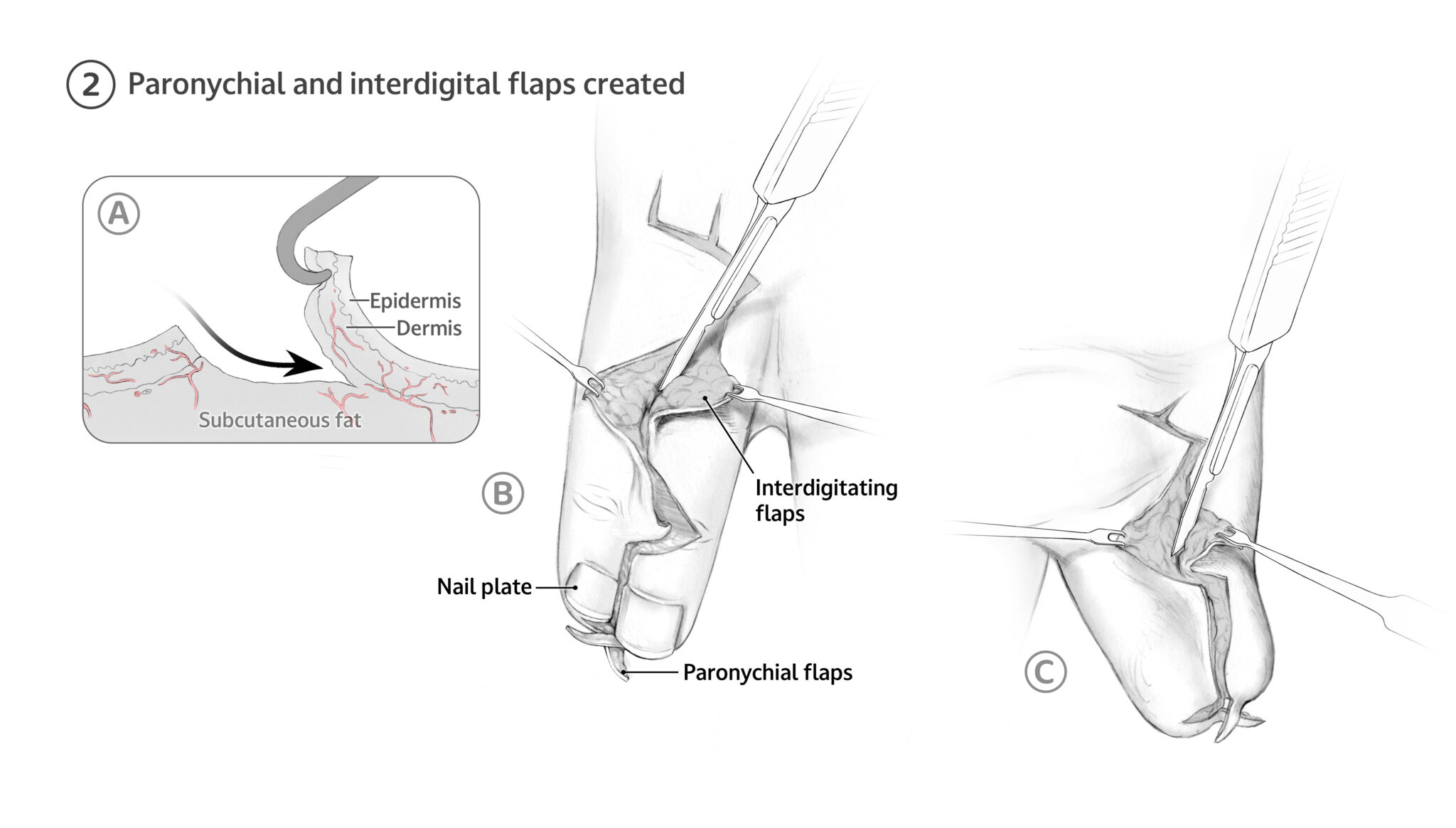 2A Beginning distally, an incision is made to mobilize the paronychial skin flaps followed by separation of the nail plate at the junction of the ring and small finger. 2A Skin flaps are elevated and retracted with care to preserve the epidermis, dermis, and sufficient subcutaneous fat to maintain flap viability. Interdigital flaps are raised distal to proximal on the dorsal side, followed by elevation of the palmar flaps.