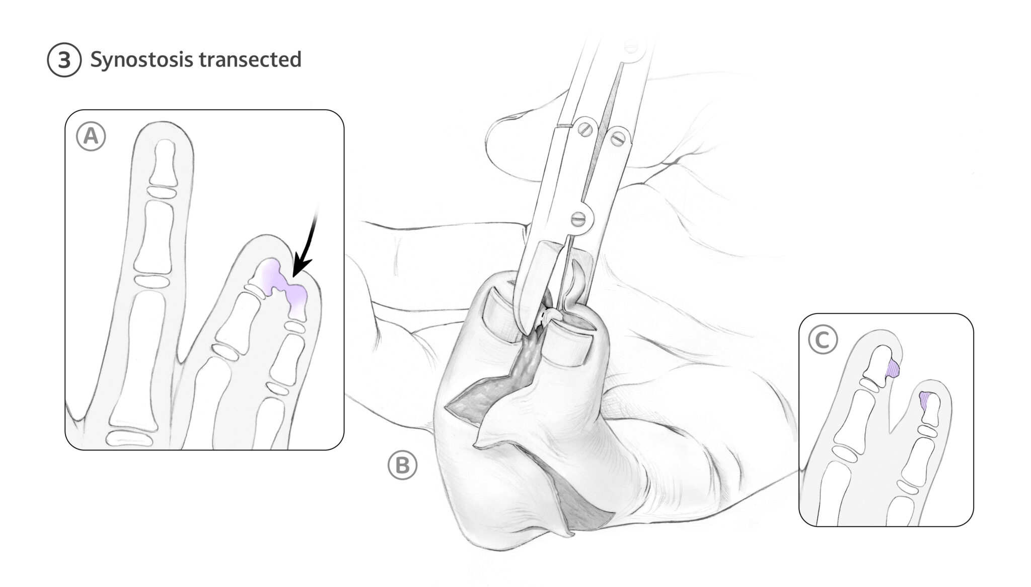 Again here we appreciate the disparity in finger length. 3A indicates synostosis between the distal ring and small phalanx which is transected using bone cutters, then smoothed with a bone rasp to restore proper alignment and contour.