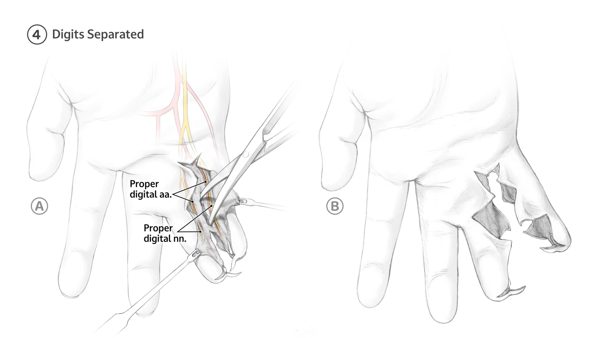 4A Using blunt dissection, the digits are separated with care taken to identify and preserve the proper digital arteries and nerves. 4B shows the completed separation.