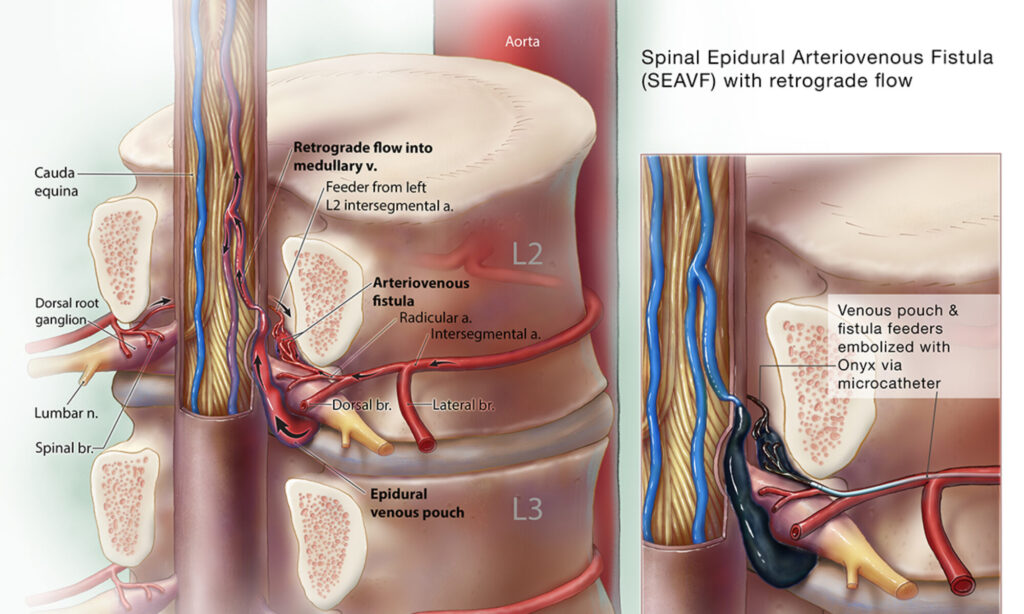 AVM spinal fistula