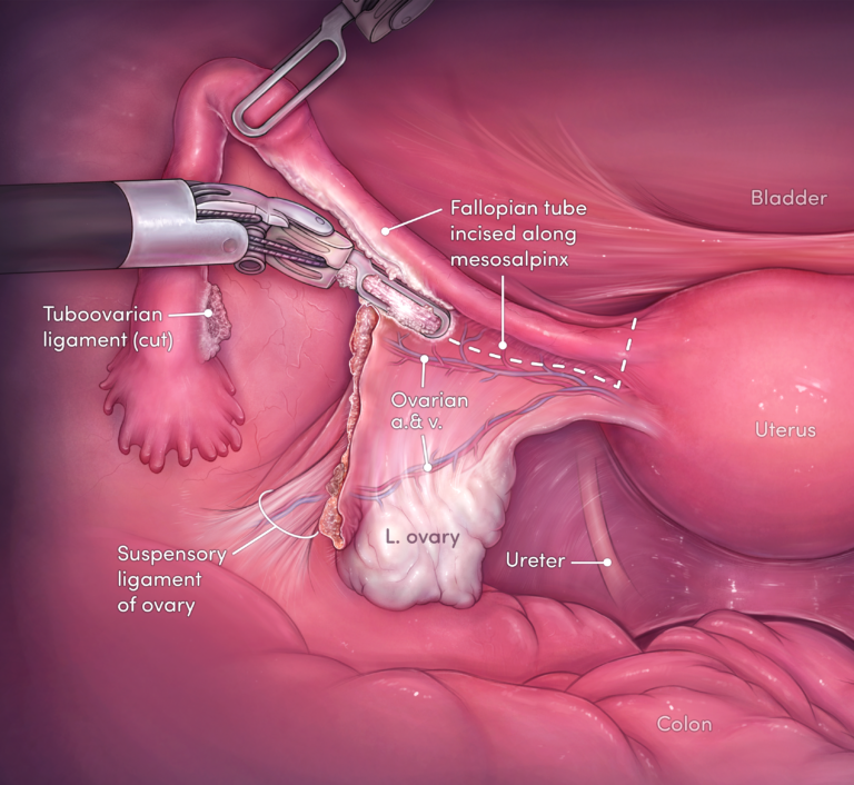 Ovary Preserving Hysterectomy surgical illustration
