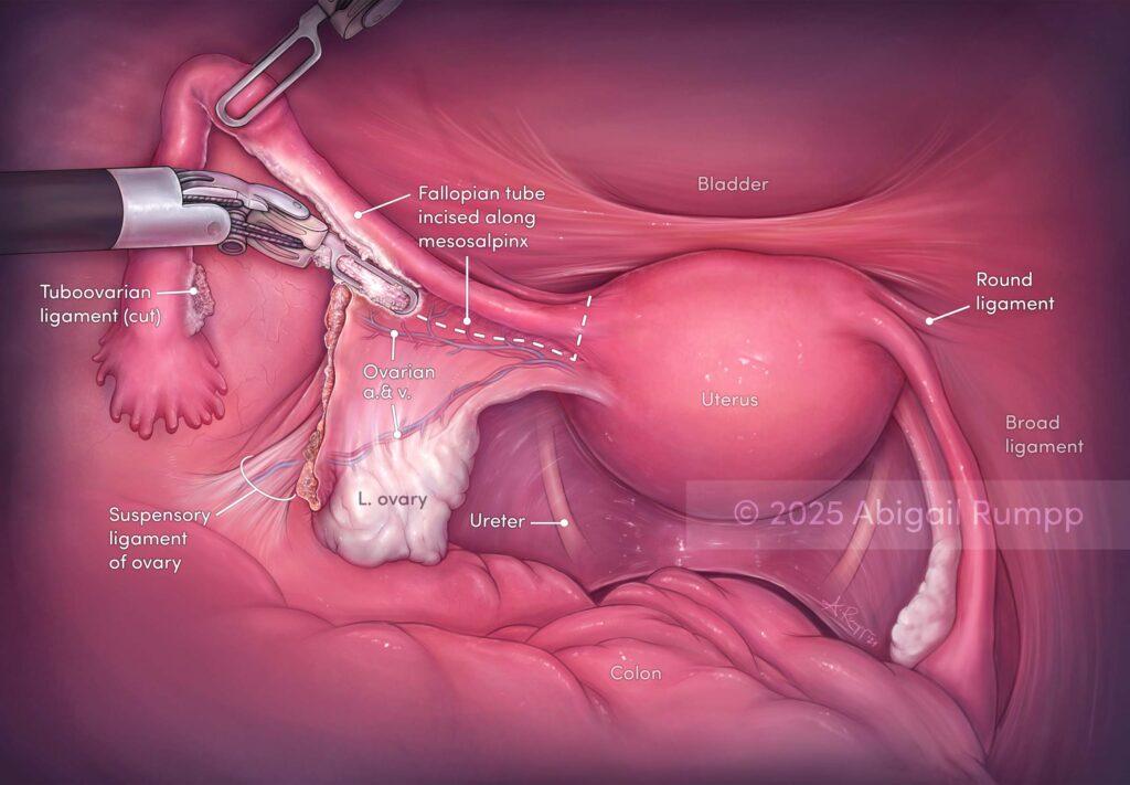 Ovary Preserving Hysterectomy